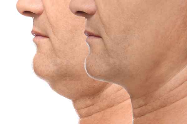 HIFU - Breakthrough in Anti - ageing 2 hifu results Coalville