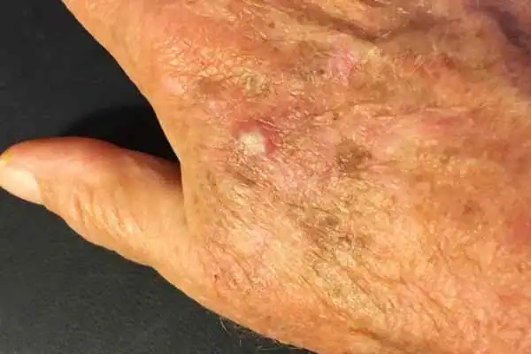 Image of Actinic keratoses Coalville on a person hand
