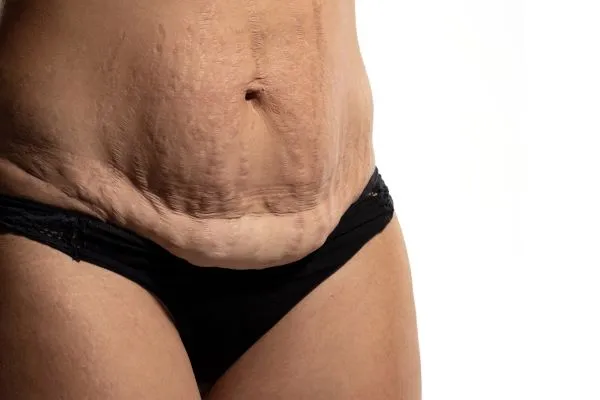 The science behind skin tightening Coalville picture of a woman's sagging skin on the stomach